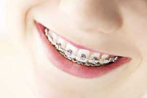 invisalign specialist